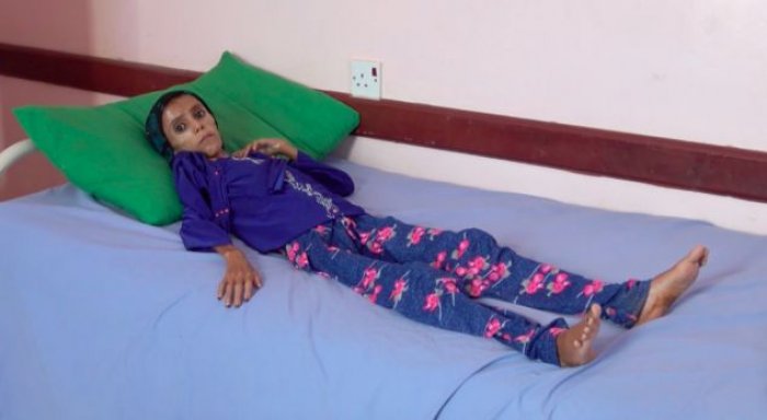 12-vjeçarja që peshon 10 kg, pasqyra e tmerrit nga lufta në Jemen