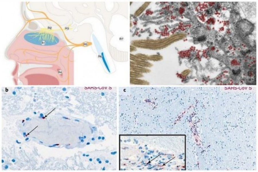 Përmes hundës dhe enëve të gjakut/ Studimi gjerman: Si futet koronavirusi në tru, pasojat e rënda tek pacientët
